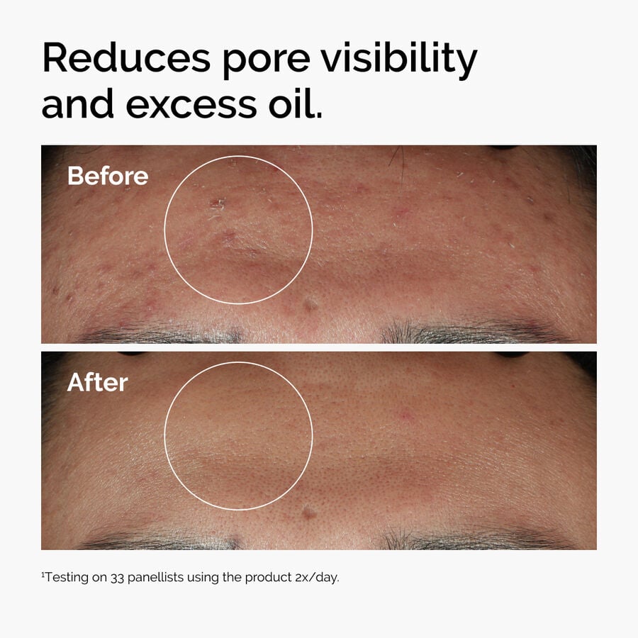 niacinamide-10-zinc-1-w2 ord-niacinamide-zinc-blemish-serum-before-after-pores.jpg