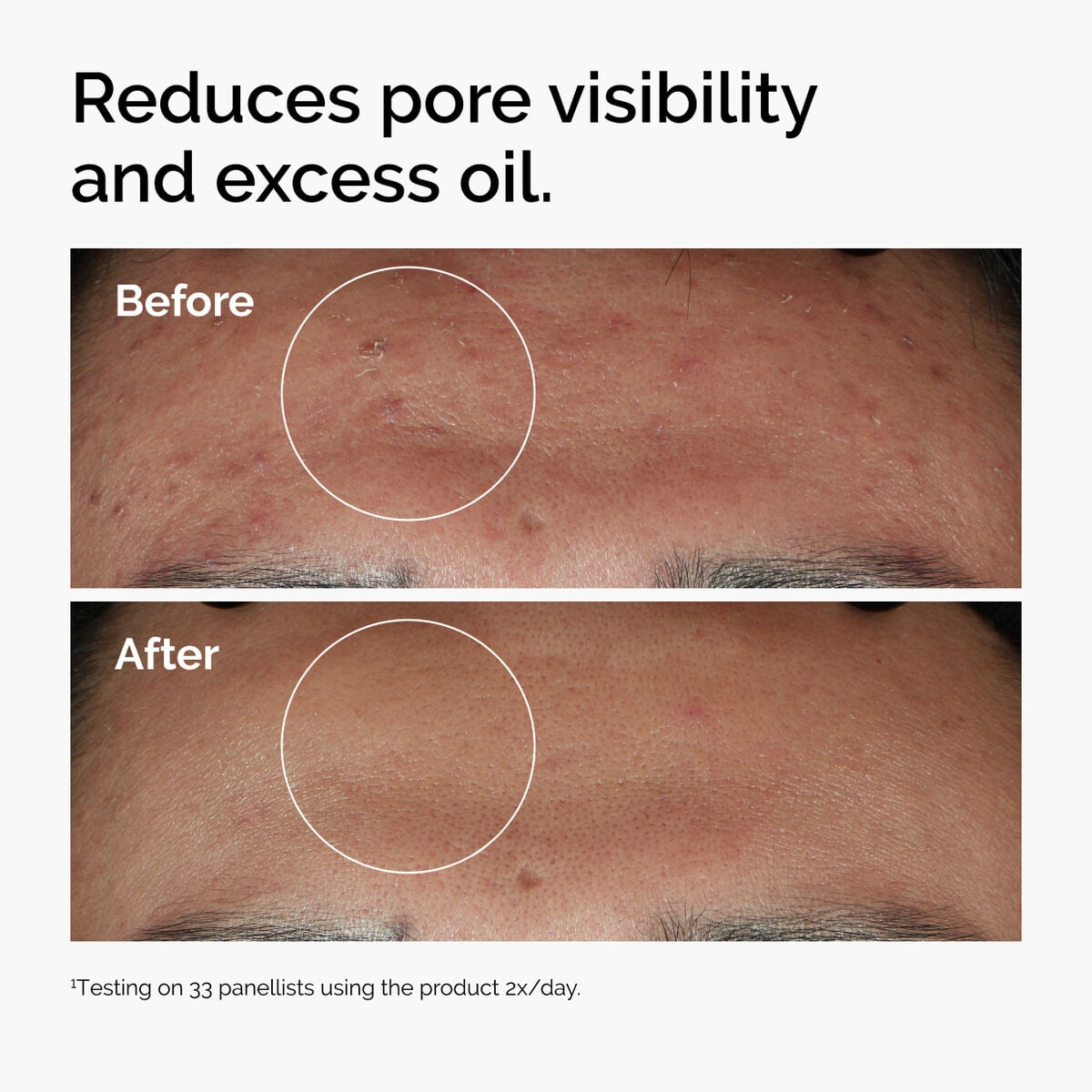 niacinamide-10-zinc-1-w2 ord-niacinamide-zinc-blemish-serum-before-after-pores.jpg