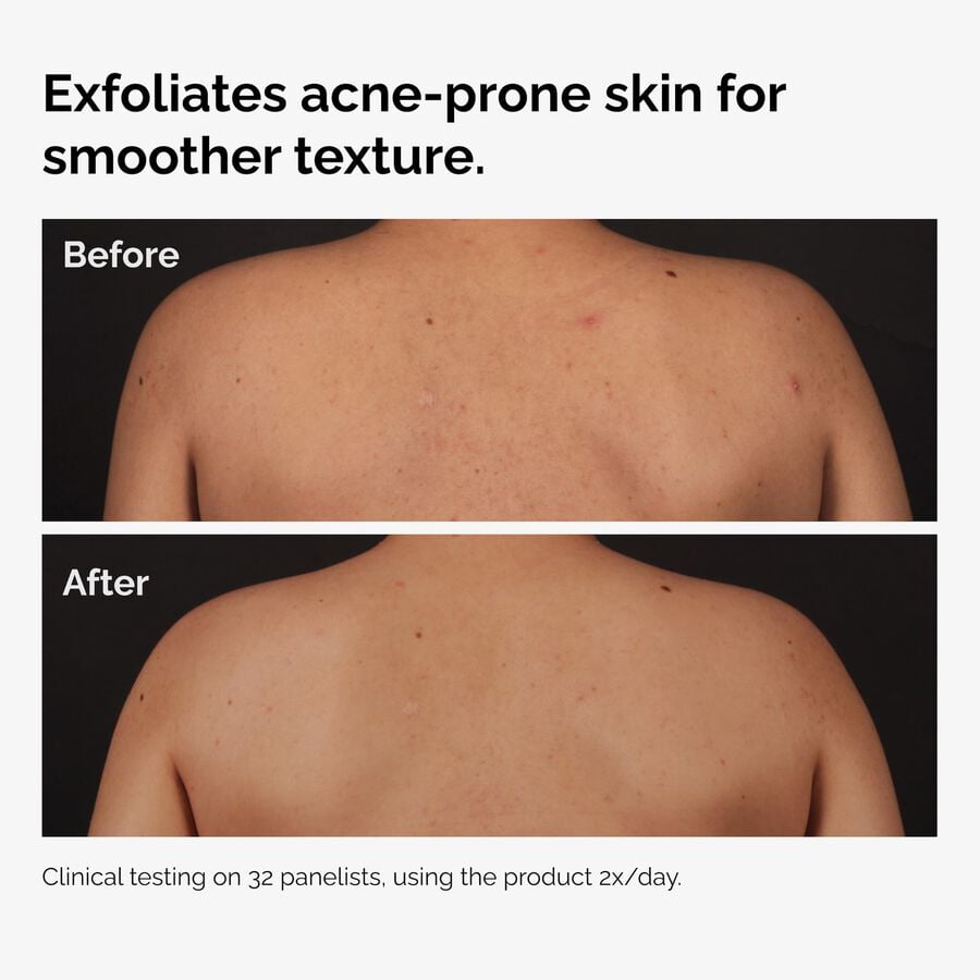 the-body-care-collection-o3 ord-salicylic-acid-body-serum-before-after-graphic-NA.jpg