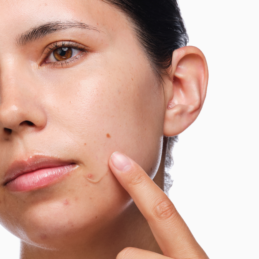 the-acne-set-e7 rdn-the-acne-set-application.png